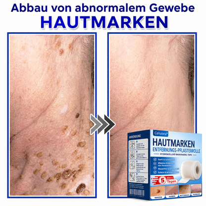 🫧🌟Celsiora® Multi-Functional Microneedle Hydrocolloid Patch Roll | Unterstützt die Pflege von Hautanhängseln, Warzen & hartnäckigen Hautunreinheiten