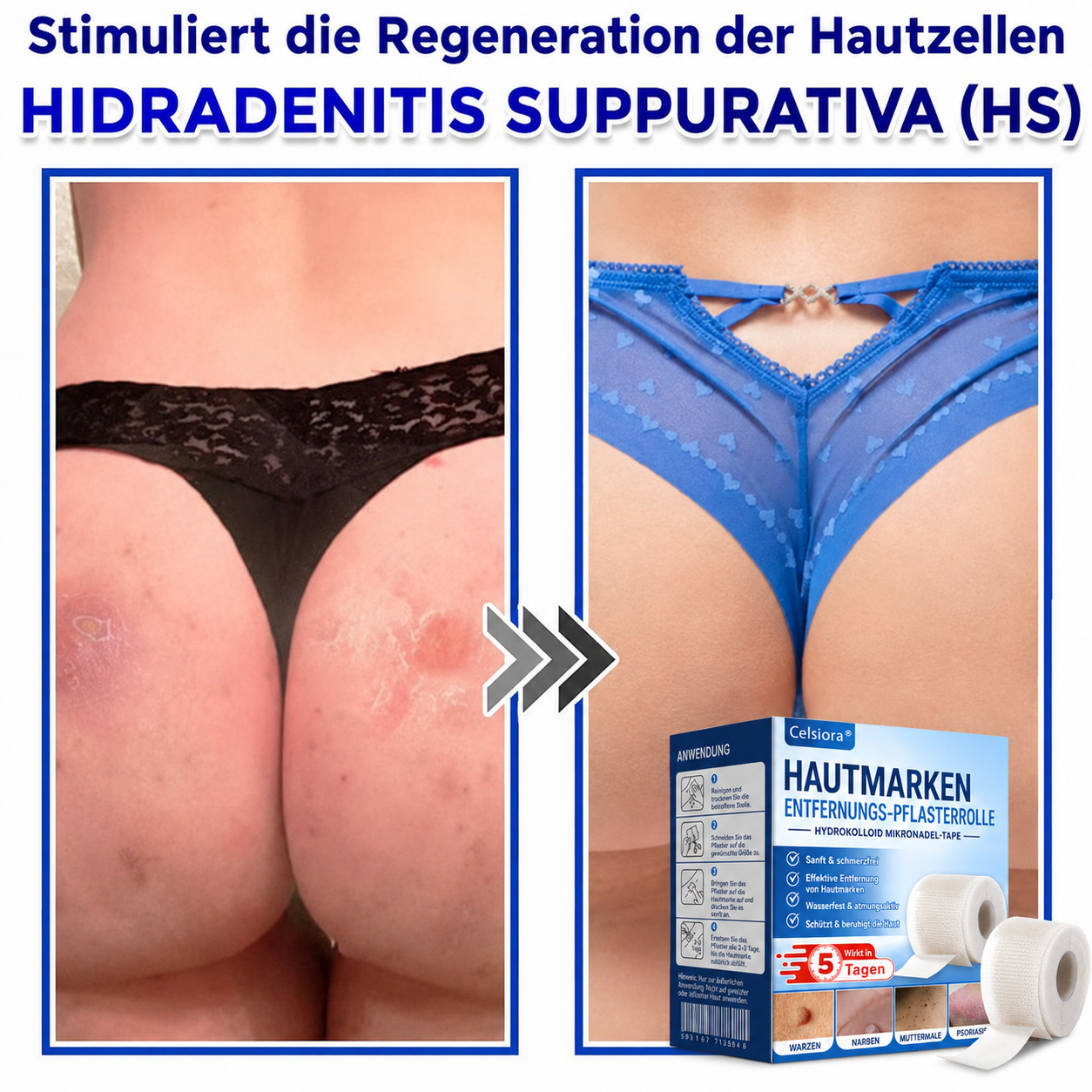🫧🌟Celsiora® Multi-Functional Microneedle Hydrocolloid Patch Roll | Unterstützt die Pflege von Hautanhängseln, Warzen & hartnäckigen Hautunreinheiten