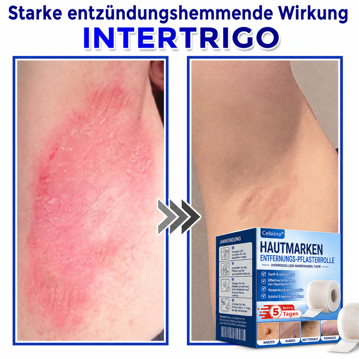 🫧🌟Celsiora® Multi-Functional Microneedle Hydrocolloid Patch Roll | Unterstützt die Pflege von Hautanhängseln, Warzen & hartnäckigen Hautunreinheiten