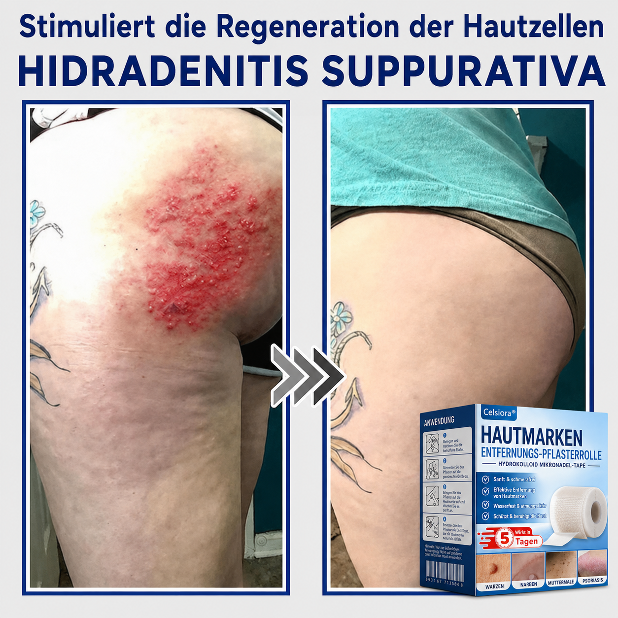 🫧🌟Celsiora® Multi-Functional Microneedle Hydrocolloid Patch Roll | Unterstützt die Pflege von Hautanhängseln, Warzen & hartnäckigen Hautunreinheiten